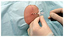 Epiduralblokade