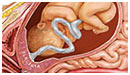Foranliggende moderkage (placenta prævia)